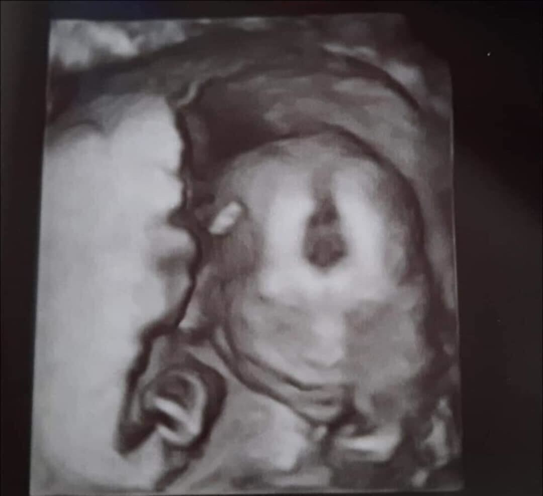 This Wisconsin mom had to go to another state for an abortion, and now for IVF